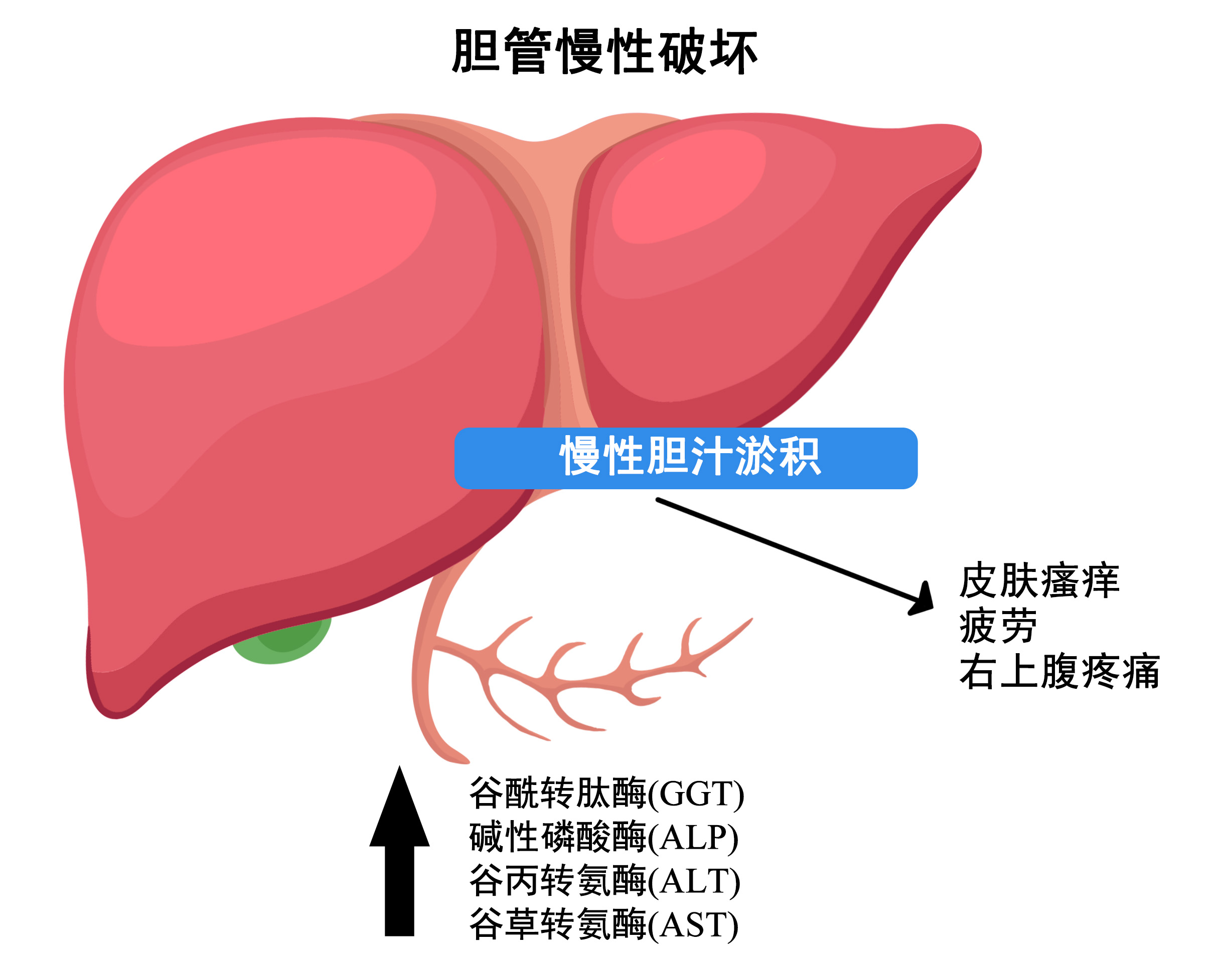 原发性胆汁性胆管炎（PBC）