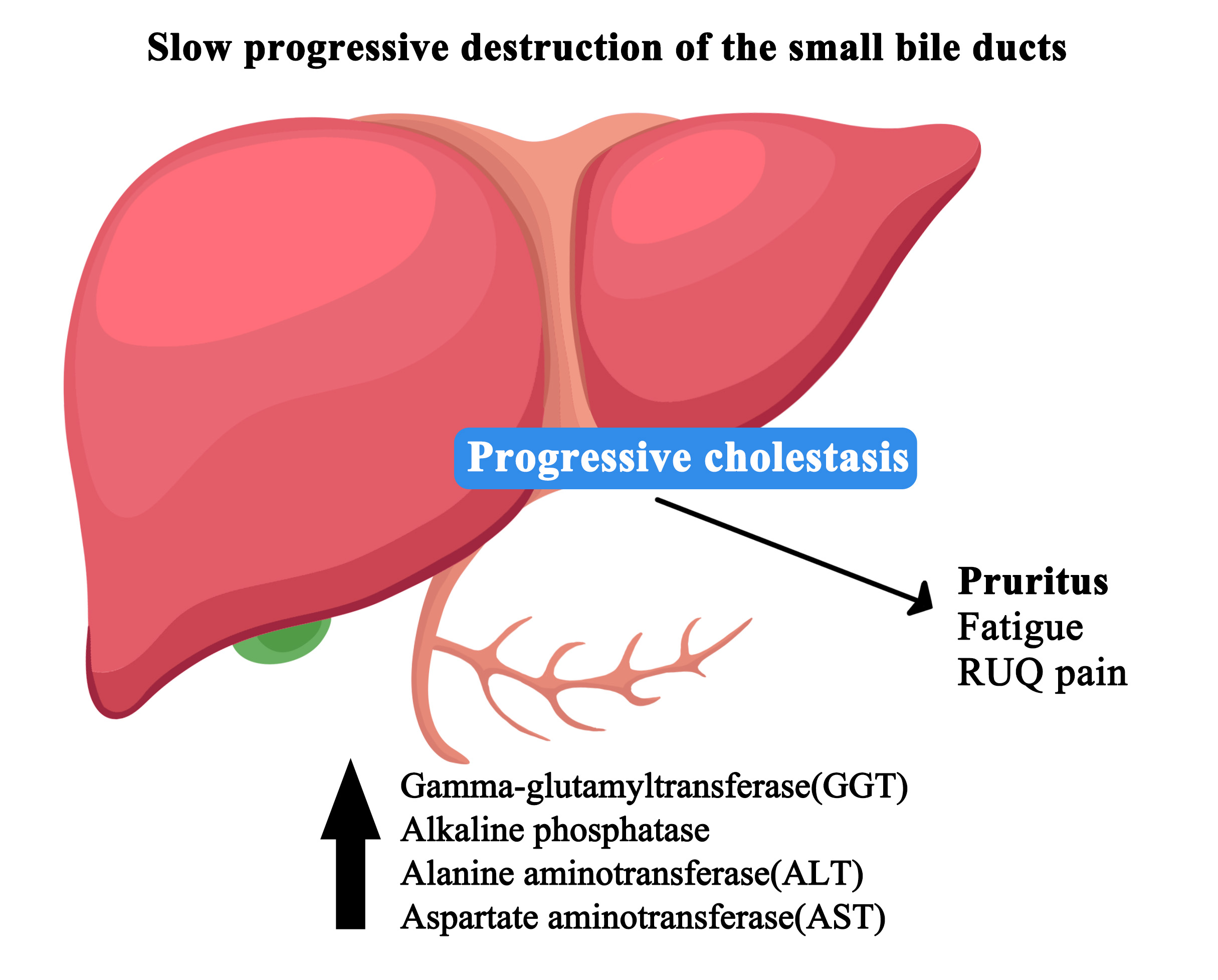 Primary Biliary Cholangitis (PBC)